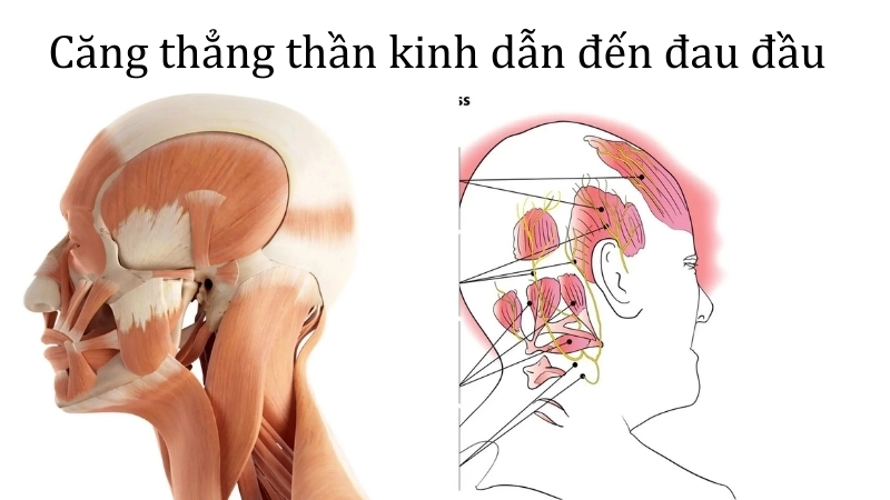 Căng thẳng thần kinh gây co thắt các cơ ở vùng đầu và cổ, dẫn đến đau đầu