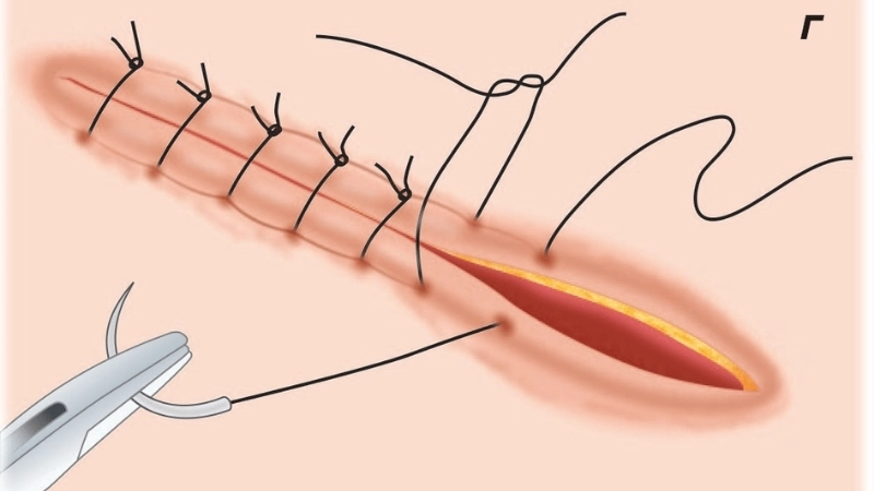  Chỉ khâu là một ứng dụng của vật liệu sinh học tự phân hủy