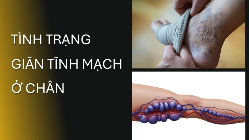 Hình ảnh mô phỏng tình trạng giãn tĩnh mạch ở chân