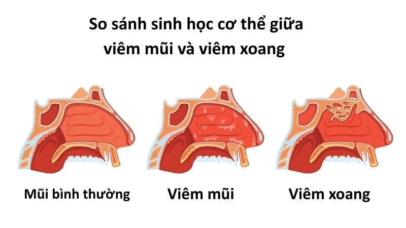 Hình ảnh so sánh sinh học cơ thể giữa viêm mũi và viêm xoang