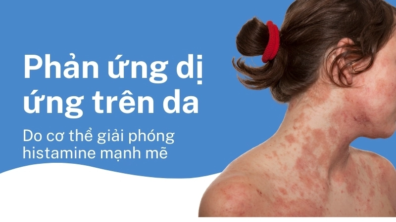 Phản ứng dị ứng trên da do cơ thể giải phóng histamine mạnh mẽ