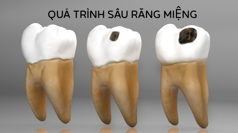  Sinh học cơ thể trong quá trình sâu răng miệng