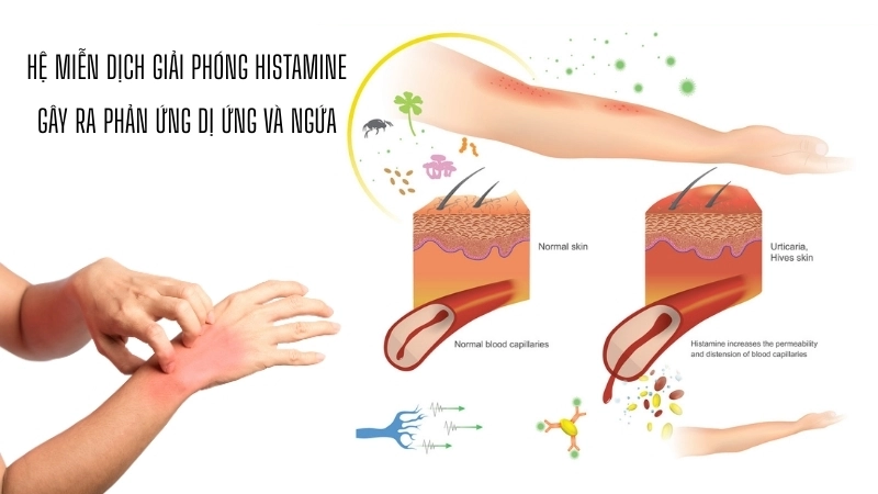Sơ đồ hệ miễn dịch giải phóng histamine gây ra phản ứng dị ứng và ngứa