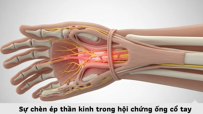 Sự chèn ép thần kinh trong hội chứng ống cổ tay
