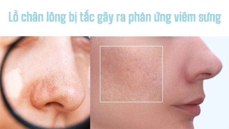  Sự phát triển của vi khuẩn trong lỗ chân lông bị tắc gây ra phản ứng viêm sưng