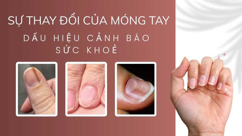  Sự thay đổi của móng có thể là một dấu hiệu ban đầu của sinh học cơ thể