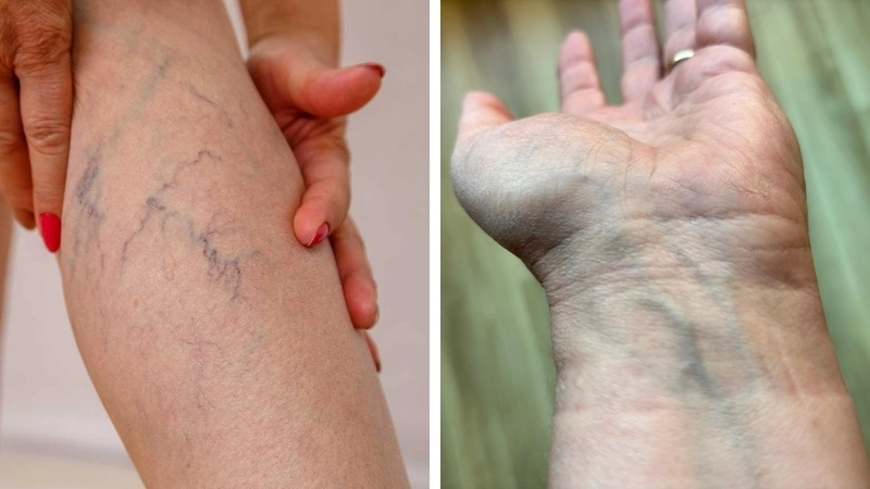 Tĩnh mạch có màu xanh là do cách ánh sáng xuyên qua da và bị tán xạ 