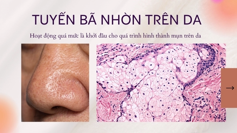  Tuyến bã nhờn hoạt động quá mức là khởi đầu cho quá trình hình thành mụn trên da