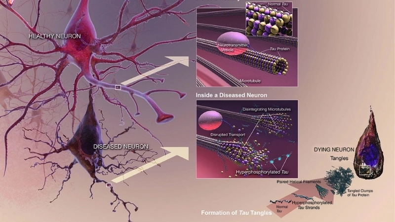  Hình ảnh mô phỏng mảng bám amyloid giữa các tế bào thần kinh