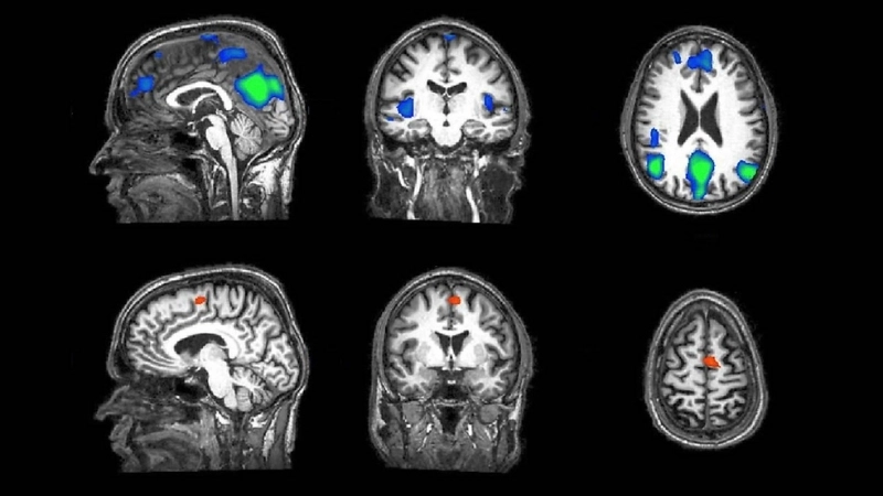  Khám phá cơ chế hoạt động của placebo qua hình ảnh fMRI não bộ